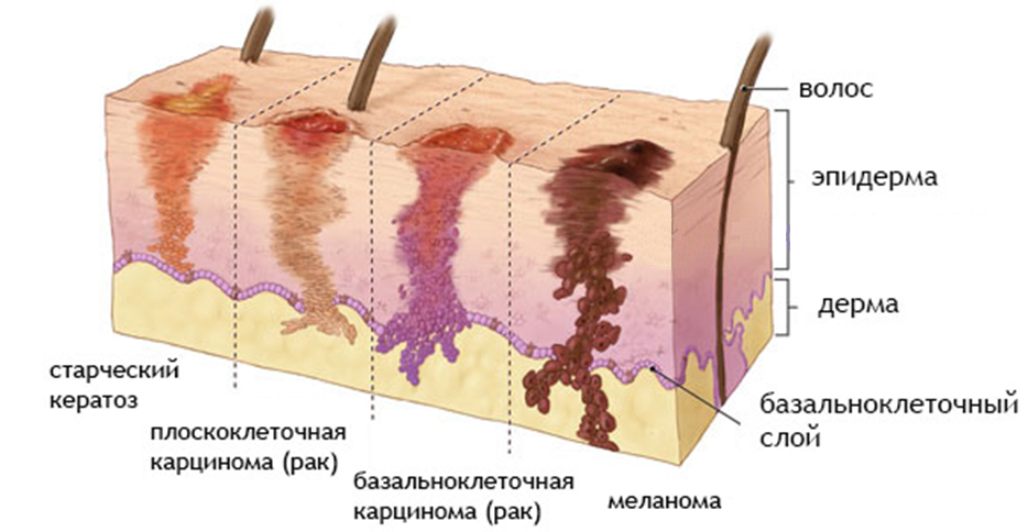 Виды злокачественных опухолей кожи фото