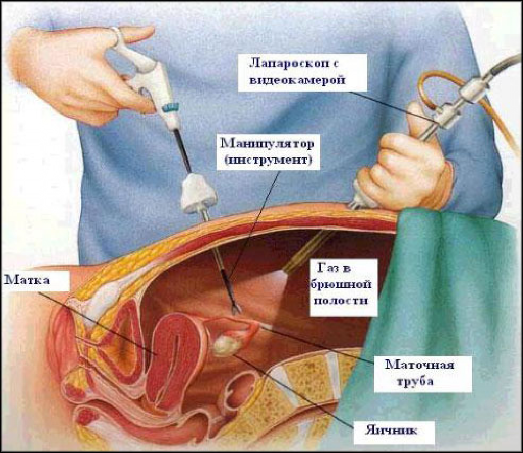 Спаечная болезнь - диагностика, лечение и причины образования спаек в брюшной полости | Альтермед