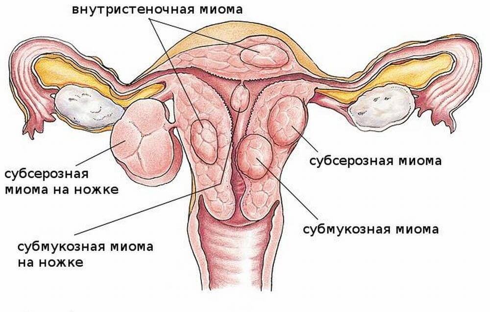 Лечу миому. Классификация миом по их расположению относительно матки. Субмукозная миома матки.