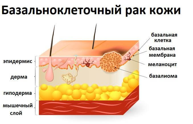 базальноклеточный рак кожи лечение фото