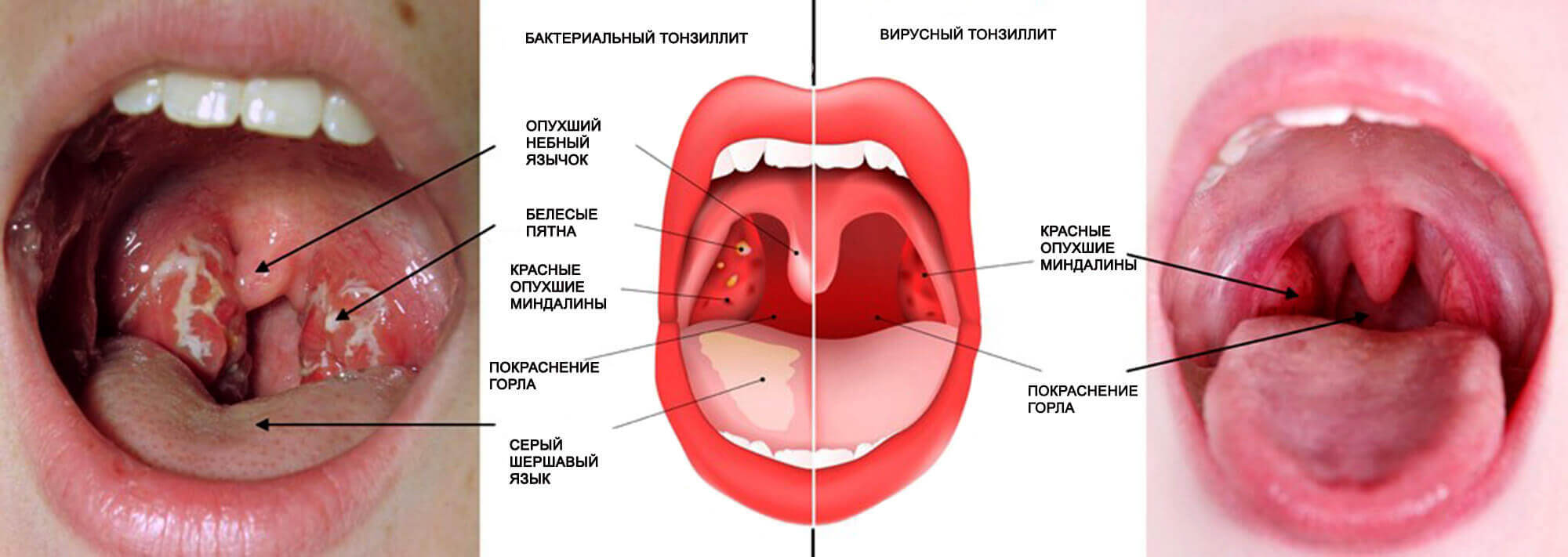 Тонзиллит - симптомы и диагностика, цены на лечение тонзиллита в Москве в клинике Хадасса